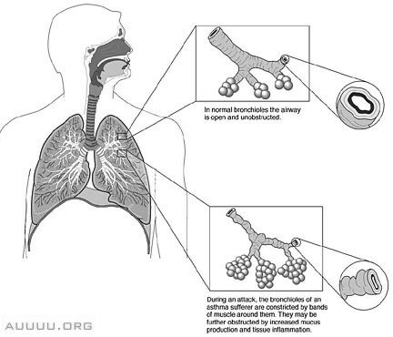 Asthma