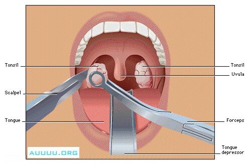 Tonsillectomy - Tonsils